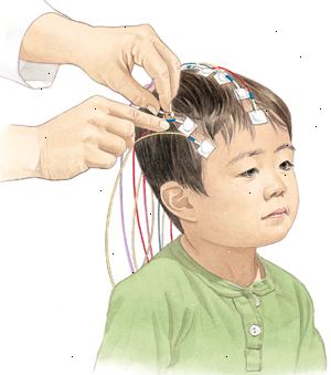 Durante un EEG, elettrodi sono posizionati sul cuoio capelluto del vostro bambino così l'attività elettrica del cervello può essere registrato.