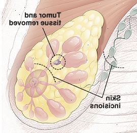 Anatomia del seno con cerchio intorno tumore nel canale mostrando tessuto da rimuovere. Ci sono linee tratteggiate sopra capezzolo e in ascella per mostrare piccoli siti di incisione curve.