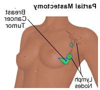 Illustrazione di una mastectomia parziale