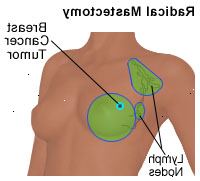 Illustrazione di una mastectomia radicale