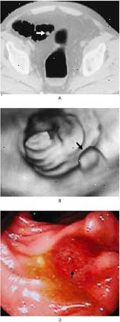 Polipi del colon-retto nel colon sigma visto da TAC (A), colonscopia virtuale (B), e la colonscopia convenzionale (C).