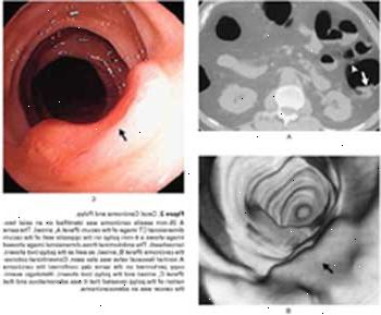 Il carcinoma del cieco e polipo visto da TAC (A), colonscopia virtuale (B), e la colonscopia convenzionale (C).