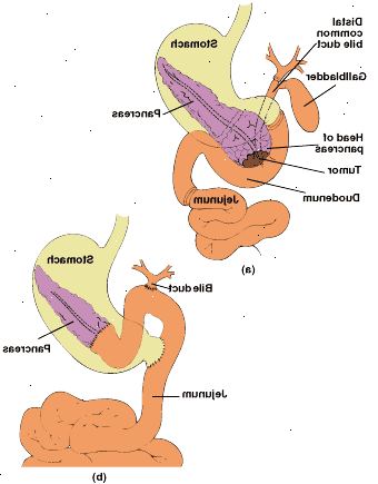 Piloro-conservazione pancreaticoduodenectomia: anatomia della zona resecato (a) e ricollegato tubo digerente con pancreatico end-to-end (b).